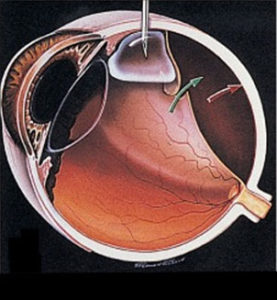 Pneumatic Retinopexy