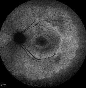 Photo using special filters to show macular changes in a patient with retinitis pigmentosa.