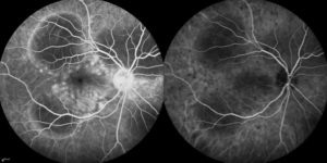 Right eye of a patient with Acute Posterior Multifocal Placoid Pigment Epitheliopathy (APMPPE), a rare inflammatory eye disease seen in young adults. The photo on the left is fluorescein angiography which highlights the blood vessels in the retina. The photo on the right is indocyanine green angiography which highlights the blood vessels under the retina.