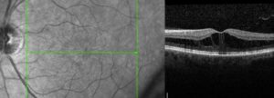 Photo on the left is of a macula with edema. The photo on the right is a cross-sectional image (OCT) of the same macula showing the swelling (macular edema).