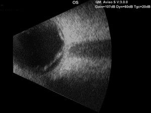 Ultrasound showing a retinal detachment in a patient with severe diabetic retinopathy.